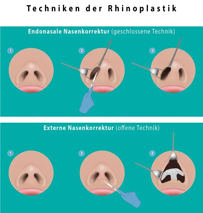 Schnitt offen vs. geschlossen